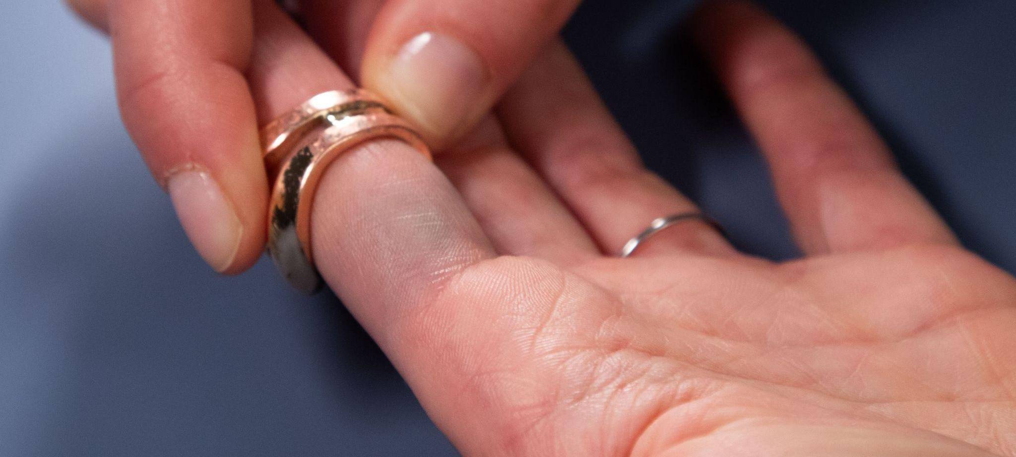 Verfärbungen durch Modeschmuck sind am Finger zu sehen