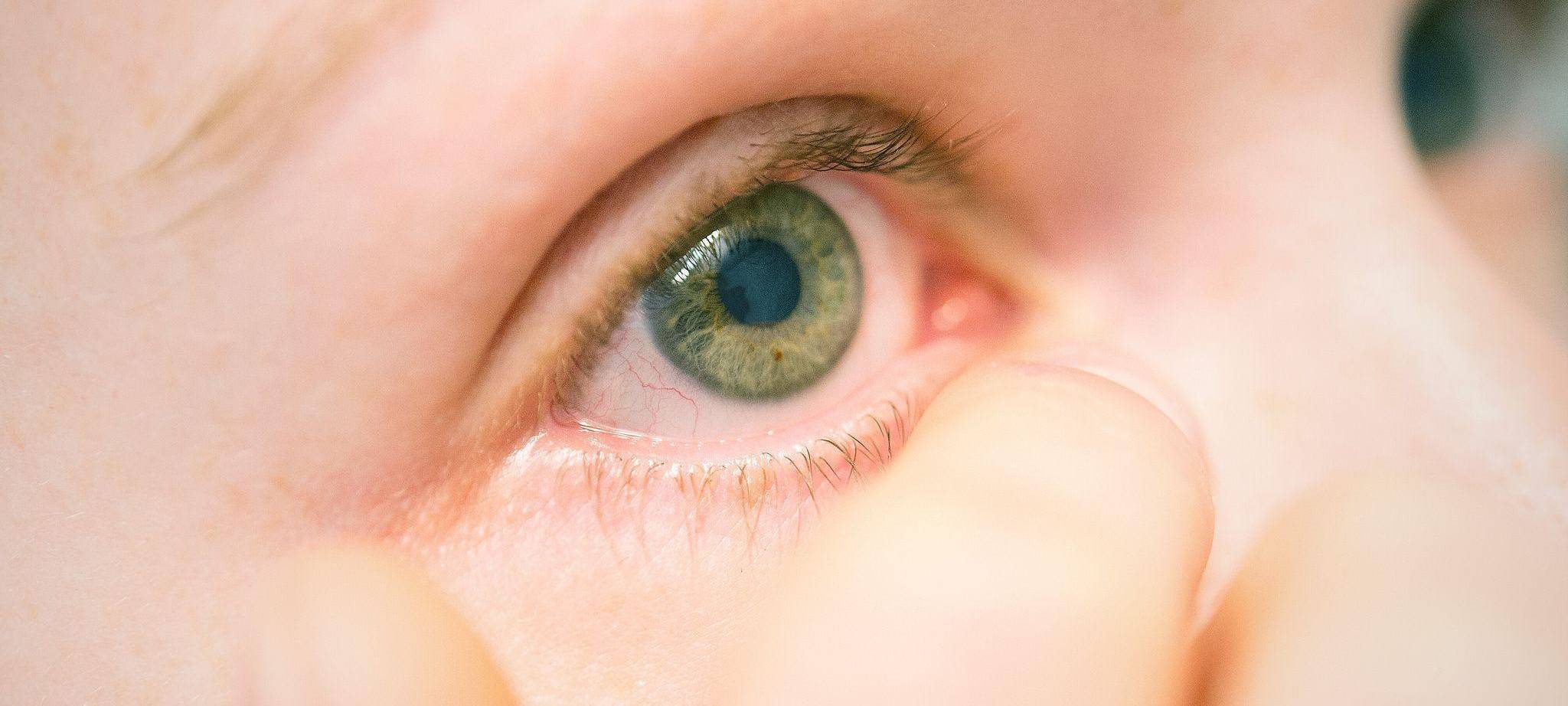 Eine Frau leidet unter einer Entzündung am Auge